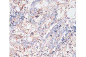 Immunohistochemistry of paraffin-embedded Human colon carcinoma using ZNRF3 Polyclonal Antibody at dilution of 1:100 (40x lens).