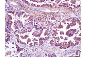 Formalin-fixed and paraffin embedded human lung carcinoma labeled with Anti-Wnt8b Polyclonal Antibody, Unconjugated (ABIN716306) at 1:200 followed by conjugation to the secondary antibody and DAB staining (WNT8B antibody  (AA 131-230))