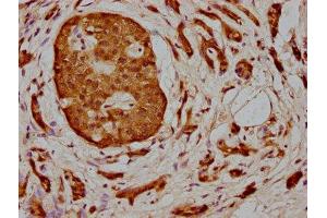 IHC image of ABIN7160033 diluted at 1:400 and staining in paraffin-embedded human pancreatic cancer performed on a Leica BondTM system. (MAP3K2 antibody  (AA 357-619))