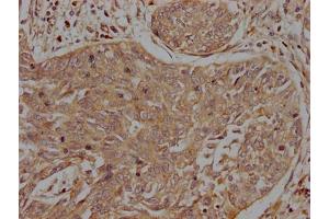 IHC image of ABIN7156340 diluted at 1:200 and staining in paraffin-embedded human cervical cancer performed on a Leica BondTM system. (INSRR antibody  (AA 747-921))