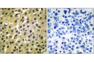 Immunohistochemistry analysis of paraffin-embedded human breast carcinoma tissue, using MDM2 Antibody.