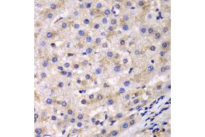 Immunohistochemistry of paraffin-embedded human liver cancer using EEF2 antibody at dilution of 1:100 (400x lens). (EEF2 antibody)