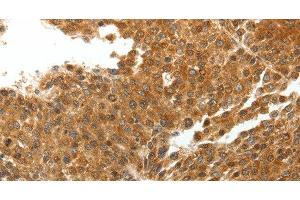 Immunohistochemistry of paraffin-embedded Human liver cancer tissue using TNXB Polyclonal Antibody at dilution 1:40 (TNXB antibody)