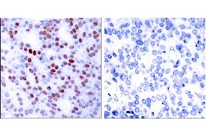 Peptide - +Immunohistochemical analysis of paraffin-embedded human breast carcinoma tissue using c-Jun (Ab-243) antibody (#B7130). (C-JUN antibody  (Ser243))