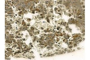 ABIN6256633 and ABIN6267212 at 1/100 staining human melanoma by IHC-P. (CDK6 antibody  (pTyr13))