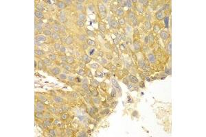 Immunohistochemistry of paraffin-embedded human lung cancer using ACTN1 antibody.