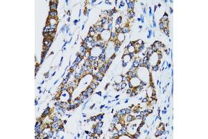Immunohistochemistry of paraffin-embedded human colon carcinoma using STAT3 antibody (ABIN6293492) at dilution of 1:100 (40x lens).