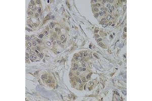 Immunohistochemistry of paraffin-embedded human breast cancer using AKT1S1 Antibody (ABIN5973672) at dilution of 1/100 (40x lens).