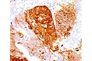IHC testing of FFPE human colon carcinoma with ALDH1 antibody (clone AHDH1-1). (ALDH1A1 antibody  (AA 315-434))