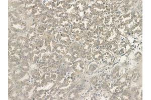 ABIN6265762 and ABIN6268946 at 1/100 staining human renal cell carcinoma by IHC-P. (TXNRD2 antibody  (C-Term))