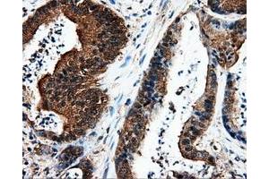 Immunohistochemical staining of paraffin-embedded liver tissue using anti-L1CAM mouse monoclonal antibody. (L1CAM antibody)