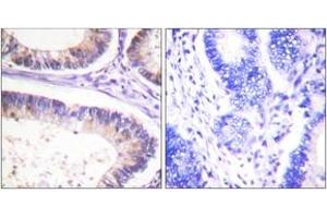 Immunohistochemistry analysis of paraffin-embedded human colon carcinoma, using CBL (Phospho-Tyr674) Antibody. (CBL antibody  (pTyr674))