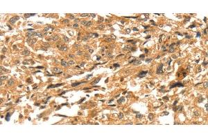Immunohistochemistry of paraffin-embedded Human esophagus cancer tissue using DIRAS1 Polyclonal Antibody at dilution 1:52 (DIRAS1 antibody)