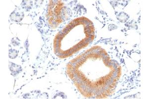 Formalin-fixed, paraffin-embedded human Melanoma stained with CD86 Mouse Monoclonal Antibody (C86/1146).