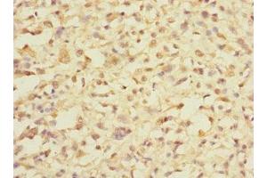Immunohistochemistry of paraffin-embedded human melanoma using ABIN7164368 at dilution of 1:100 (DDX59 antibody  (AA 1-200))
