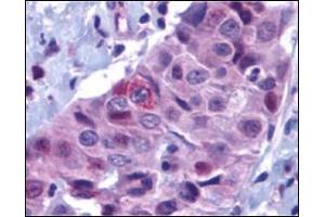 Immunohistochemistry of PUMA in human breast carcinoma with PUMA antibody at 10 μg/ml. (PUMA antibody  (N-Term))