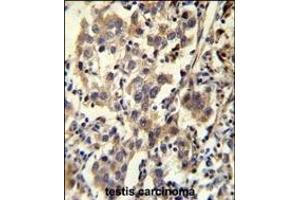 CCD Antibody (C-term) (ABIN655703 and ABIN2845154) immunohistochemistry analysis in formalin fixed and paraffin embedded human testis carcinoma followed by peroxidase conjugation of the secondary antibody and DAB staining. (CCDC110 antibody  (C-Term))