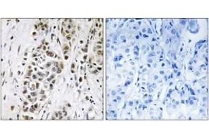 Immunohistochemistry analysis of paraffin-embedded human breast carcinoma tissue, using XRN2 Antibody. (Renin-2 antibody  (AA 81-130))