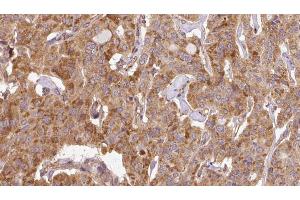 ABIN6267115 at 1/100 staining Human thyroid cancer tissue by IHC-P. (EIF4G1 antibody  (pSer1147))
