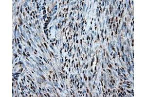 Immunohistochemical staining of paraffin-embedded Adenocarcinoma of ovary tissue using anti-HSPA1Amouse monoclonal antibody. (HSP70 1A antibody)
