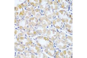 Immunohistochemistry of paraffin-embedded human stomach cancer using ANKRD52 antibody. (ANKRD52 antibody  (AA 450-660))