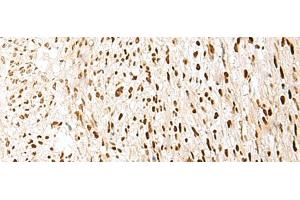 Immunohistochemistry of paraffin-embedded Human liver cancer tissue using PRPF3 Polyclonal Antibody at dilution of 1:35(x200) (PRPF3 antibody)