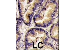 Formalin-fixed and paraffin-embedded human lung carcinoma tissue reacted with VEGF2 antibody (Center) (ABIN390259 and ABIN2837933) , which was peroxidase-conjugated to the secondary antibody, followed by DAB staining. (VEGFB (VEGF2) (AA 110-139) antibody)