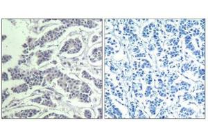 Immunohistochemical analysis of paraffin-embedded human breast carcinoma tissue using AKT1/AKT2/AKT3(Phospho-Tyr315/316/312) Antibody(left) or the same antibody preincubated with blocking peptide(right).