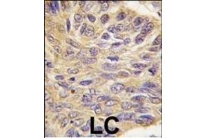 Formalin-fixed and paraffin-embedded human lung carcinoma tissue reacted with MEG2 antibody (C-term), which was peroxidase-conjugated to the secondary antibody, followed by DAB staining. (PTPN9 antibody  (C-Term))