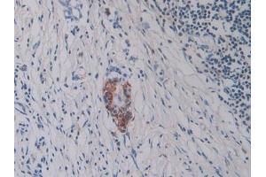 Detection of Hepc in Human Pancreatic cancer Tissue using Monoclonal Antibody to Hepcidin (Hepc) (Hepcidin antibody  (AA 25-84))
