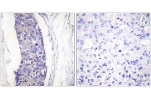 Immunohistochemistry analysis of paraffin-embedded human breast carcinoma tissue, using Tubulin alpha Antibody.