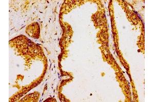 Immunohistochemistry of paraffin-embedded human prostate cancer using ABIN7154296 at dilution of 1:100 (GOLPH3 antibody  (AA 16-150))