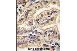 Formalin-fixed and paraffin-embedded human lung carcinoma tissue reacted with CSF1R polyclonal antibody  , which was peroxidase-conjugated to the secondary antibody, followed by DAB staining. (CSF1R antibody  (C-Term))