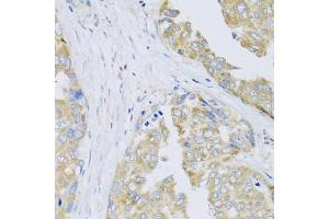 Immunohistochemistry of paraffin-embedded human liver cancer using ARFGAP3 antibody (ABIN5974520) at dilution of 1/100 (40x lens). (ARFGAP3 antibody)