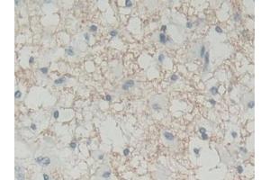 Detection of BLVRB in Human Glioma Tissue using Polyclonal Antibody to Biliverdin Reductase B (BLVRB)