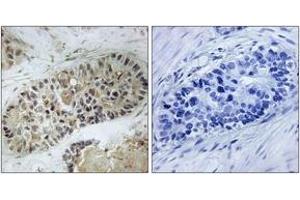Immunohistochemistry analysis of paraffin-embedded human lung carcinoma, using Artemis (Phospho-Ser516) Antibody. (DCLRE1C antibody  (pSer516))