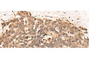 Immunohistochemistry of paraffin-embedded Human thyroid cancer tissue using CLK2 Polyclonal Antibody at dilution of 1:45(x200) (CLK2 antibody)