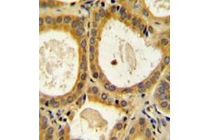 Formalin fixed and paraffin embedded human prostate carcinoma reacted with CD152 / CTLA4 Antibody (N-term) followed by peroxidase conjugation of the secondary antibody and DAB staining. (CTLA4 antibody  (N-Term))