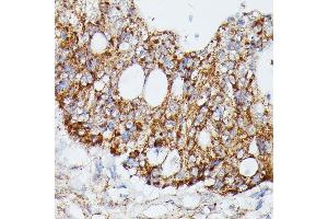 Immunohistochemistry of paraffin-embedded human colon carcinoma using MK4 antibody (ABIN7268654) at dilution of 1:100 (40x lens).