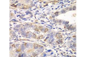 Immunohistochemistry of paraffin-embedded Human gastric cancer using GCLM Polyclonal Antibody at dilution of 1:100 (40x lens). (GCLM antibody)