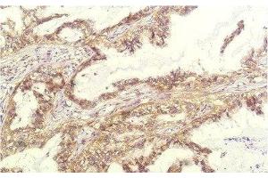 Immunohistochemistry of paraffin-embedded Human lung carcinoma tissue using IL8 Monoclonal Antibody at dilution of 1:200. (IL-8 antibody)