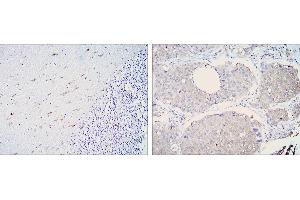 Immunohistochemical analysis of paraffin-embedded cerebellum tissues (left) and lung cancer (right) using ALDH1A1 mouse mAb with DAB staining. (ALDH1A1 antibody)