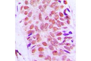 Immunohistochemical analysis of RPS8 staining in human breast cancer formalin fixed paraffin embedded tissue section. (RPS8 antibody  (Center))