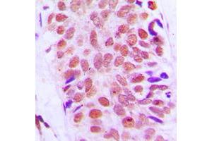 Immunohistochemical analysis of RPS8 staining in human breast cancer formalin fixed paraffin embedded tissue section.