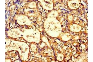 Immunohistochemistry of paraffin-embedded human gastric cancer using ABIN7171428 at dilution of 1:100 (CCT8 antibody  (AA 224-491))