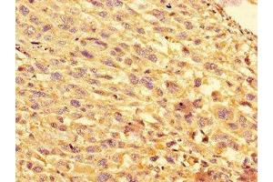 Immunohistochemistry of paraffin-embedded human melanoma using ABIN7152193 at dilution of 1:100 (eIF4EBP1 antibody  (AA 2-111))