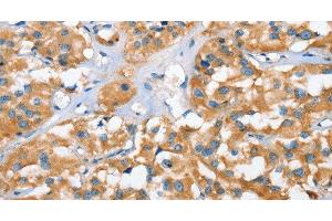 Immunohistochemistry of paraffin-embedded Human thyroid cancer tissue using CXCL14 Polyclonal Antibody at dilution 1:40 (CXCL14 antibody)