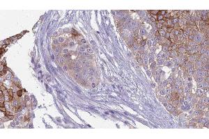 ABIN6277846 at 1/100 staining Human urothelial cancer tissue by IHC-P. (INSRR antibody  (N-Term))