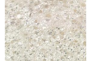 ABIN6258365 and ABIN6274357 at 1/100 staining human astrocytoma by IHC-P.
