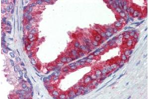 Human Prostate (formalin-fixed, paraffin-embedded) stained with FASN antibody ABIN462322 followed by biotinylated goat anti-rabbit IgG secondary antibody ABIN481713, alkaline phosphatase-streptavidin and chromogen. (Fatty Acid Synthase antibody  (AA 942-973))